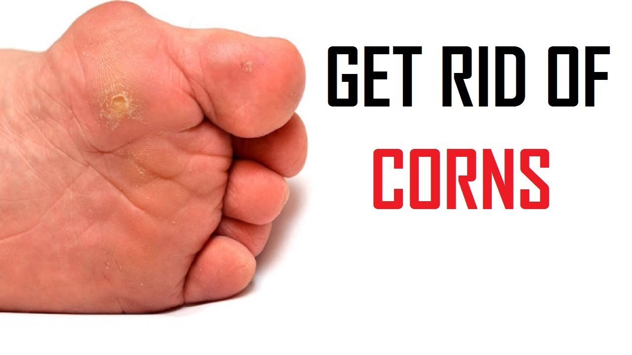 How To Get Rid Of Corns On Feet | How To Remove Corns On Feet - YouTube