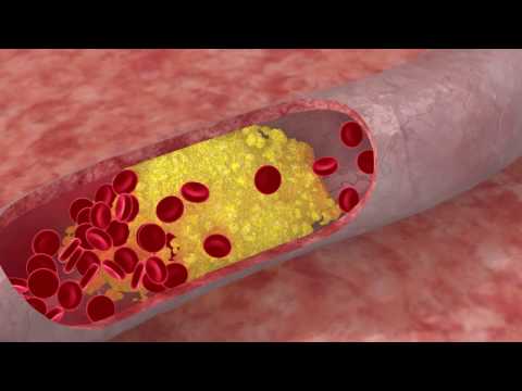 DISLIPIDEMIA. ¿Qué es?