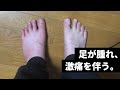 食生活が乱れた挙句、痛風になったブラック企業社員の末路。／A day of gout.