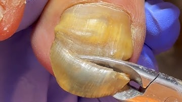 A Collection Of Bad Toenails! Remove Fungus Step By Step【Dr. Liu
