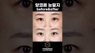 [Before&amp;After] 앙코르눈밑지방재배치 l 르미엘성형외과