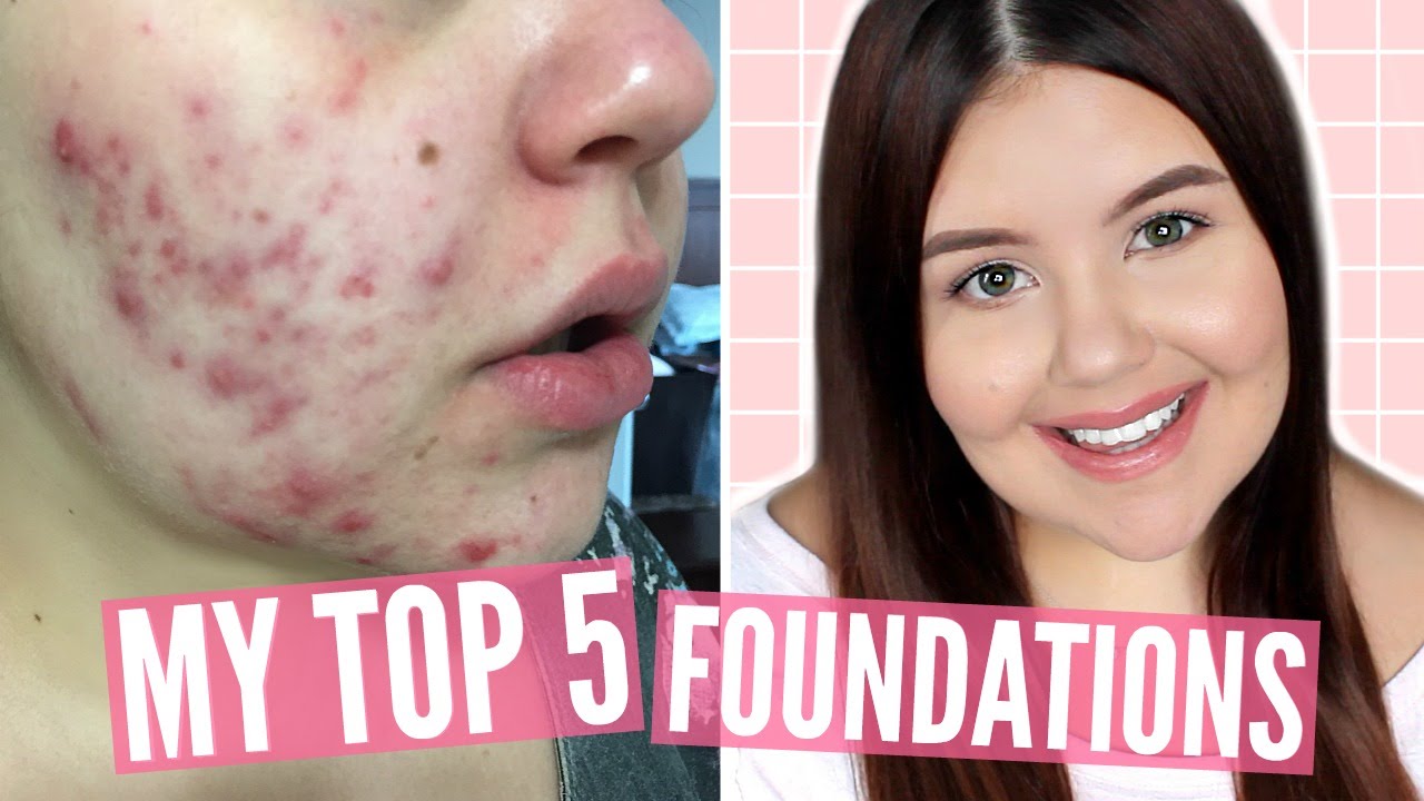 best foundation cystic acne