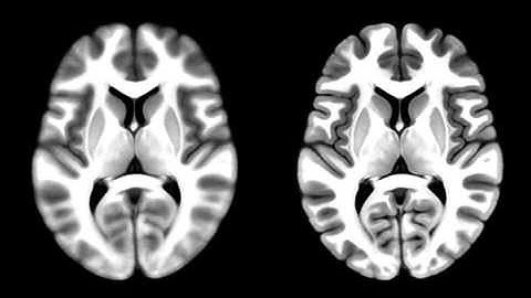 AFNI 3dQwarp vs FSL FNIRT - the axial view