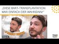 Bart Haartransplantation vorher nachher: "Ich genieße die Vorteile des vollen Barthaars!"