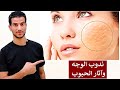 وصفة سحرية لازالة اثار الحبوب وندبات الوجه والجلد في اسرع وقت 