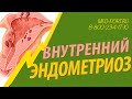 Внутренний эндометриоз. Разрастание эндометрия. Аденомиоз