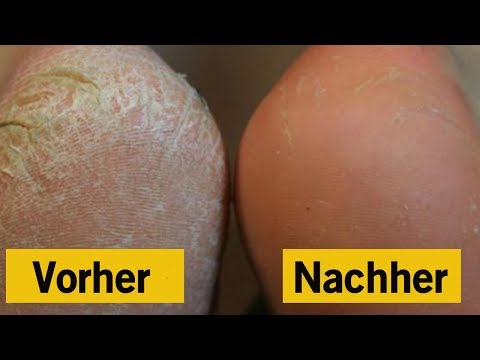 Video: 3 Möglichkeiten, trockene Knöchel zu behandeln