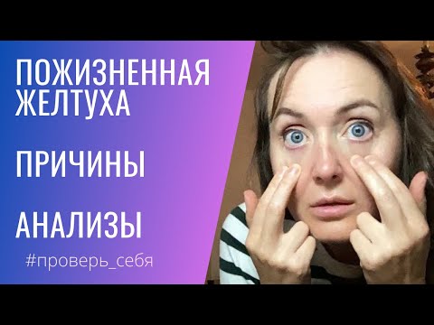 ЖЕЛТЫЕ белки глаз говорят что.... Синдром ЖИЛЬБЕРА. Высокий БИЛИРУБИН.