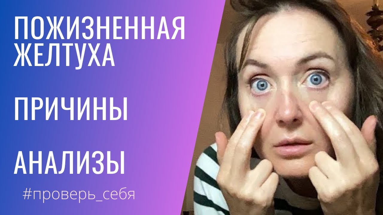 ЖЕЛТЫЕ белки глаз говорят что.... Синдром ЖИЛЬБЕРА. Высокий БИЛИРУБИН.