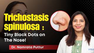 The Real Reason Your Nose Black Dots Won’t Go Away! | Trichostasis Spinulosa Explained | Clear Skin