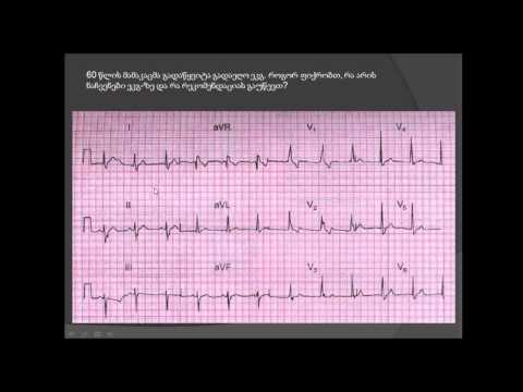 ეკგ ანალიზი / შეუღლებული ბლოკადა (ორკონოვანი ბლოკადა) / მარცხენა წინა ჰემიბლოკი