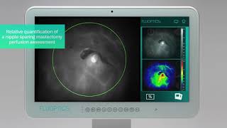 FLUOBEAM® IN ACTION - Plastic and reconstructive surgery - Breast reconstruction