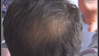 Conozca las razones de la caída del pelo y cómo evitarlo
