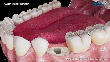 Volution - 3D Surgical Protocol