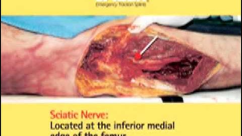 The Science of Traction Splinting