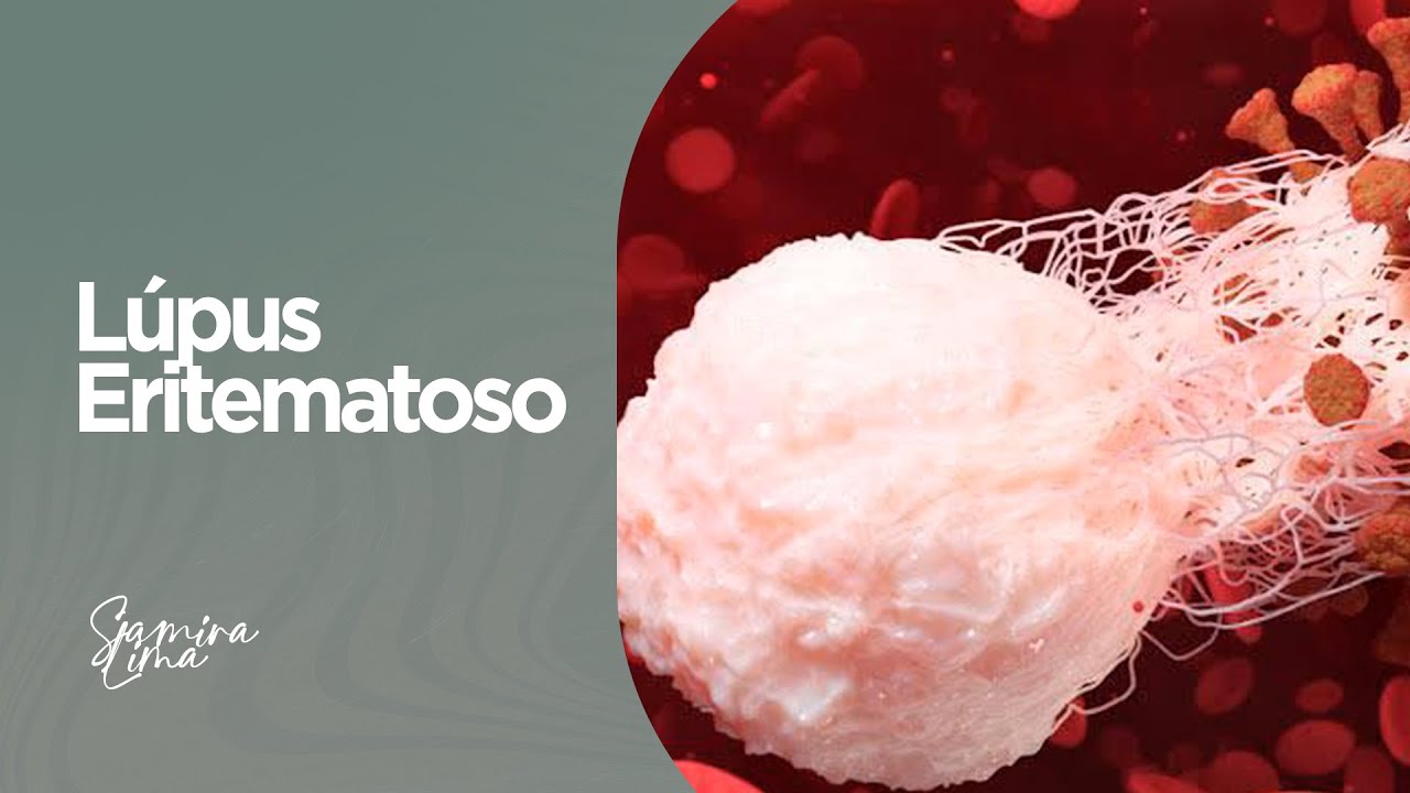 Doenças autoimunes: Lúpus Eritematoso