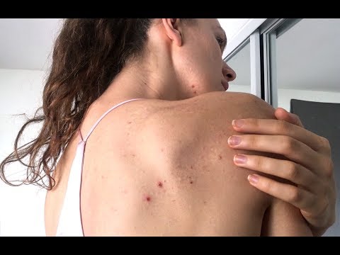 BODY ACNE (Back, Chest, Butt, Arms, Legs)