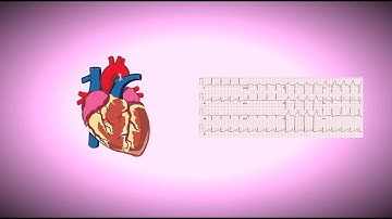 Locate a Heart Attack on an EKG/ ECG for Med Students!