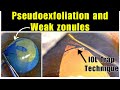 Pseudoexfoliation  weak zonules  iol trap technique dr deepak megur