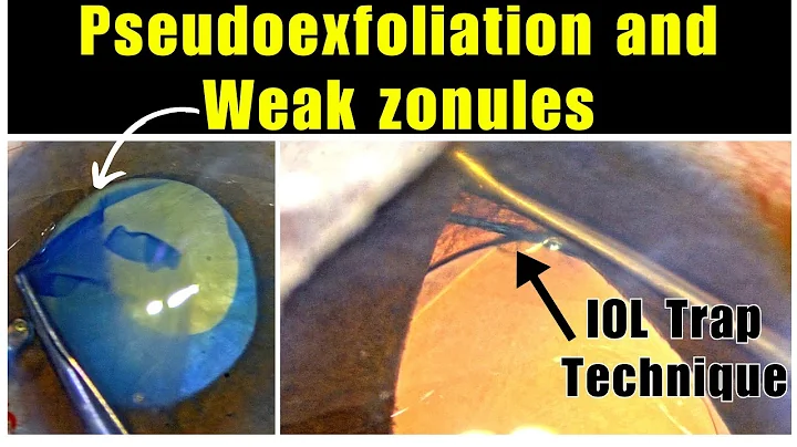 Pseudoexfoliation & Weak zonules " IOL Trap Technique" Dr. Deepak Megur - DayDayNews