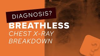 Chest X-Ray breakdown: a guide to pulmonary oedema