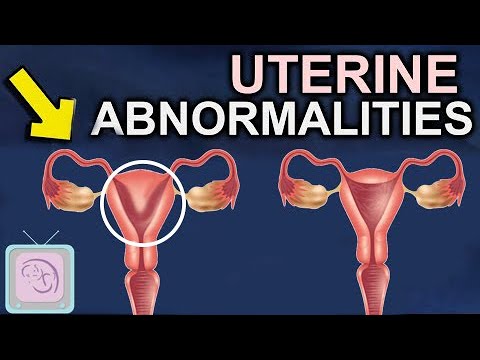 वीडियो: क्या आपका गर्भाशय एकतरफा हो सकता है?