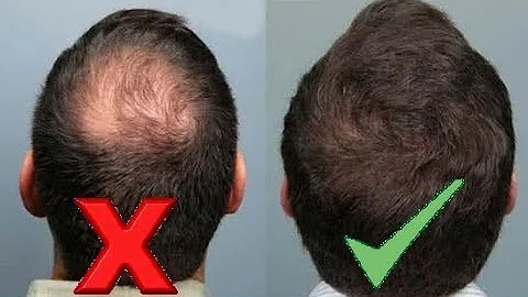 O que leva a pessoa ficar careca?