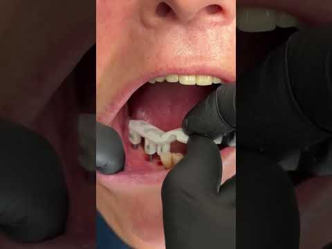 Video: 3 Möglichkeiten, einen losen Zahn herauszuziehen
