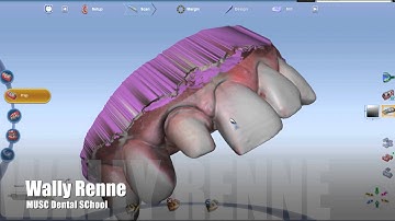 Planscan Planmeca FIT emax MT crown anterior