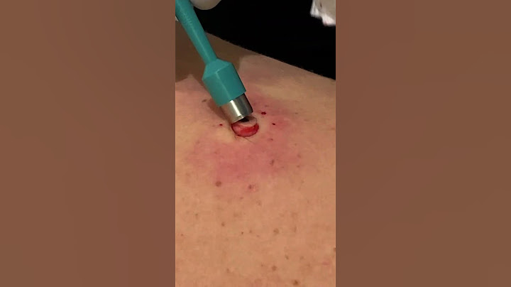 QUICK BACK POP |  PT 1  #pimplepopper #thedoc #cyst #blackheads #satisfying