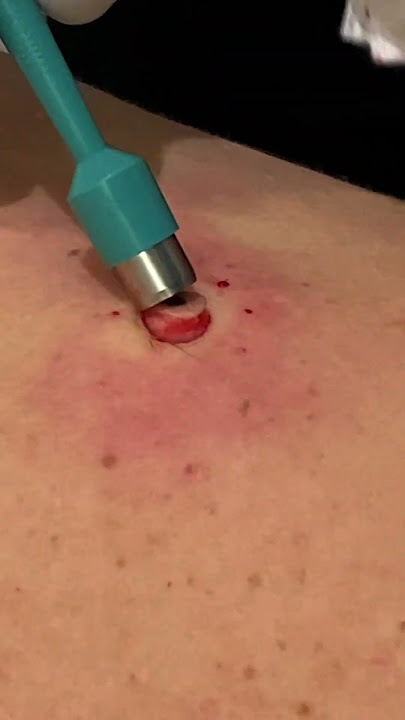 QUICK BACK POP |  PT 1  #pimplepopper #thedoc #cyst #blackheads #satisfying