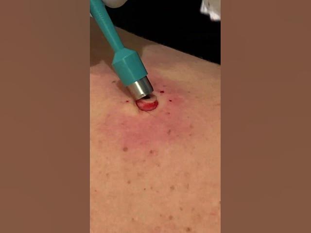QUICK BACK POP |  PT 1  #pimplepopper #thedoc #cyst #blackheads #satisfying