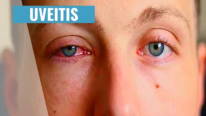 Uveitis | Red Eyes - Causes, Symptoms & Treatment (PLAB 1 Ophthalmology Review)
