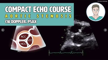 〖Echocardiography〗 Aortic stenosis - CW Doppler 5-ChV & the PSAX 🫀