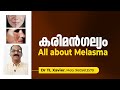 All about melasma  hyper pigmentation  karimangalyam    dr t l xavier