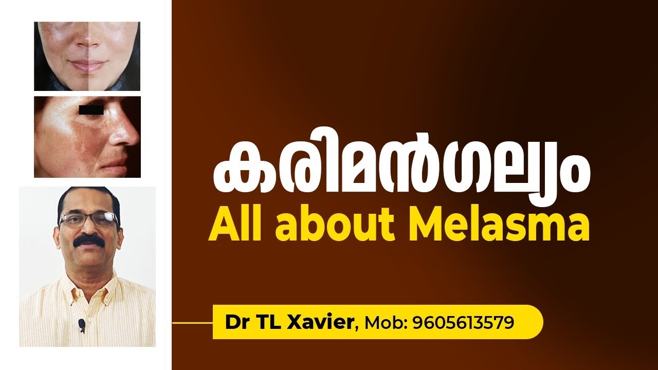 All about Melasma | Hyper Pigmentation | Karimangalyam | കരിമൻഗല്യം | Dr T L Xavier