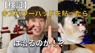 【検証】キズパワーパッドでニキビは治るのか！？