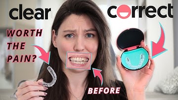 Things I wish I knew before getting ClearCorrect- pain, price and more!