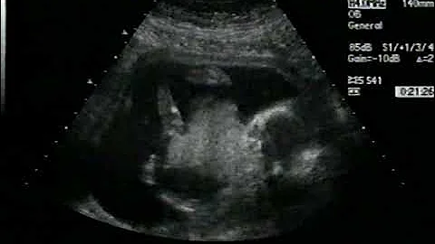 Elizabeth Meier Ultrasound 110703