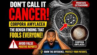Why Corpora Amylacea Mimics Prostate Cancer | Avoiding Common False Positive Ultrasound Reports