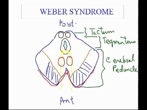 Weber Syndrome