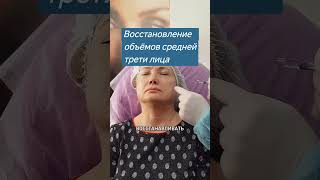 Восстановление объёмов средней трети лица филлерами.