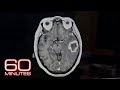 Frontotemporal dementia  60 minutes archive