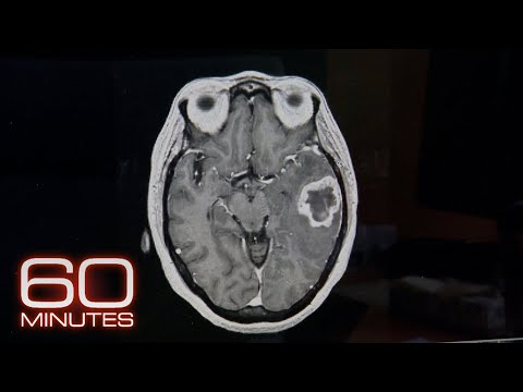 Video: Ar frontotemporalinė demencija gali jus nužudyti?