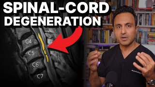 Spinal cord degeneration (myelomalacia) surgical treatment