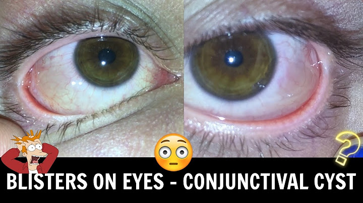 ♡ Bubbles On Your Eyeball • Conjunctival Chemosis/Cyst ♡