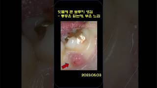 crack치아 + 잇몸 뾰루지 치유 #뿌리염증 #플라즈마신경치료 #플라젠