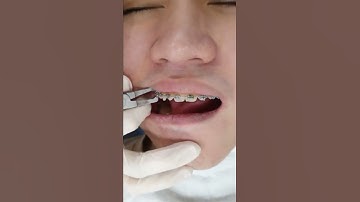 Tháo Mắc Cài Hàm Trên - Tháo Niềng Răng Hàm Trên - Niềng Răng Mắc Cài - Niềng Răng Thẩm Mỹ