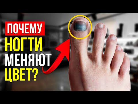 КАКИЕ ЕСТЬ БОЛЕЗНИ НОГТЕЙ? ДИСТРОФИЯ! Виды и Советы! (Подолог РЕКОМЕНДУЕТ!)