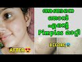 My Pimples & Acne Clearing Journey | Oh! God Finally I Removed My Pimples😌